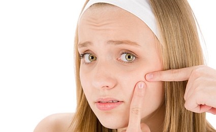 5 ways to Cure Pimples naturally !